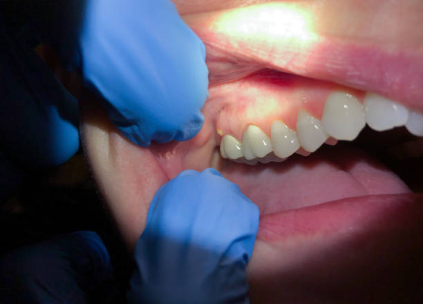Best Emergency Wisdom Teeth Removal in Roaring Spring, PA