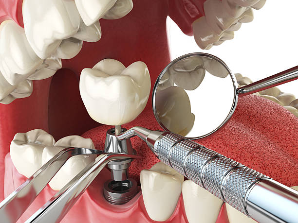 Best Emergency Tooth Extraction in Roaring Spring, PA